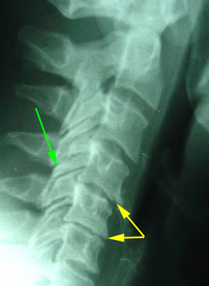 disc degeneration treated at Dr. Paulette Hugulet, DC, LLC