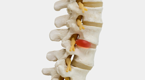 La Grande chiropractic conservative care helps even giant disc herniations go away