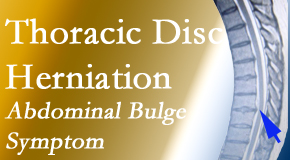 Paulette Hugulet, DC, LLC treats thoracic disc herniation that for some patients prompts abdominal pain.