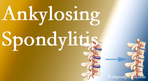 Dr. Paulette Hugulet, DC, LLC offers gentle chiropractic spinal manipulation in the form of Cox Technic for ankylosing spondylitis management.