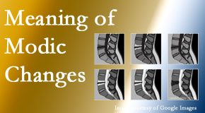 Paulette Hugulet, DC, LLC sees many back pain and neck pain patients who bring their MRIs with them to the office. Modic changes are often seen. 