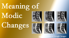Dr. Paulette Hugulet, DC, LLC sees many back pain and neck pain patients who bring their MRIs with them to the office. Modic changes are often noted.