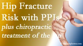 Dr. Paulette Hugulet, DC, LLC shares new research describing increased risk of hip fracture with proton pump inhibitor use.