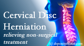 Dr. Paulette Hugulet, DC, LLC uses the Cox® Technic spinal manipulation to treat cervical radiculopathy and avert surgery.