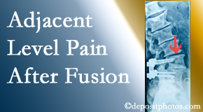 Paulette Hugulet, DC, LLC offers relieving care non-surgically to back pain patients suffering with adjacent level pain after spinal fusion surgery.