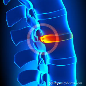 picture of lumbar La Grande disc herniation