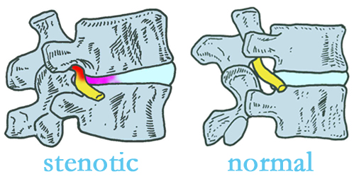La Grande stenotic and normal spinal discs